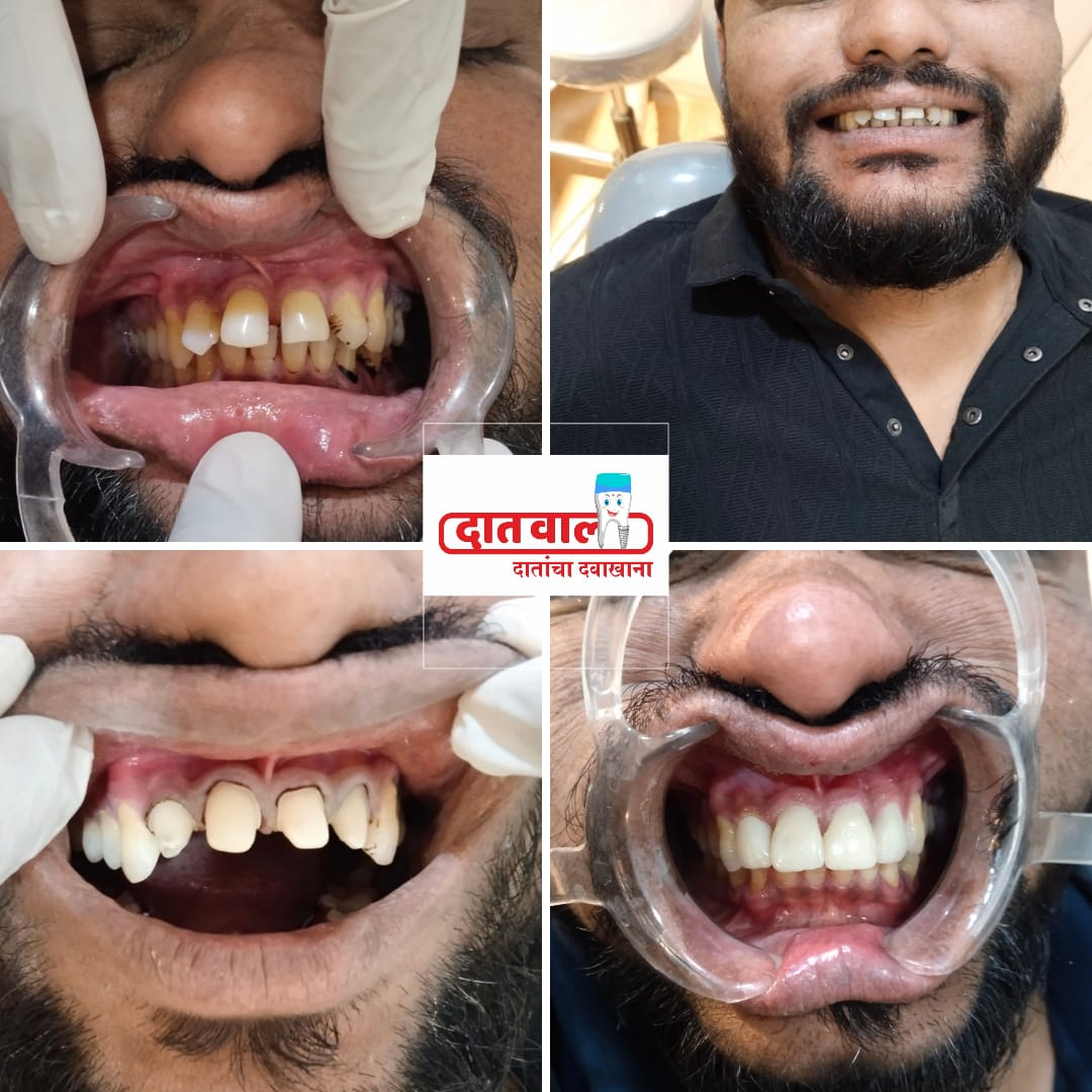 Dental Implants